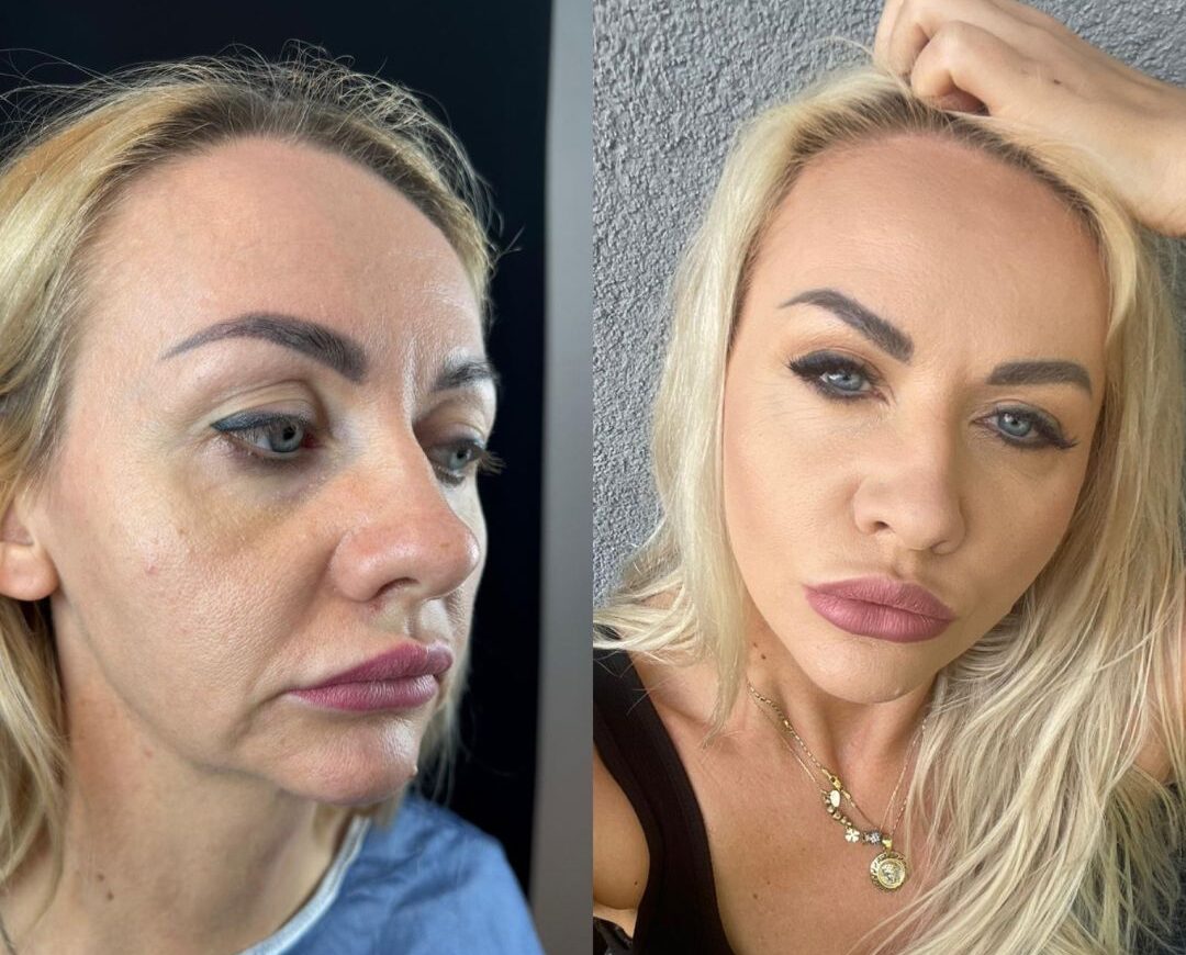 Isabella Beauty Fly | Turismo estético en Estambul