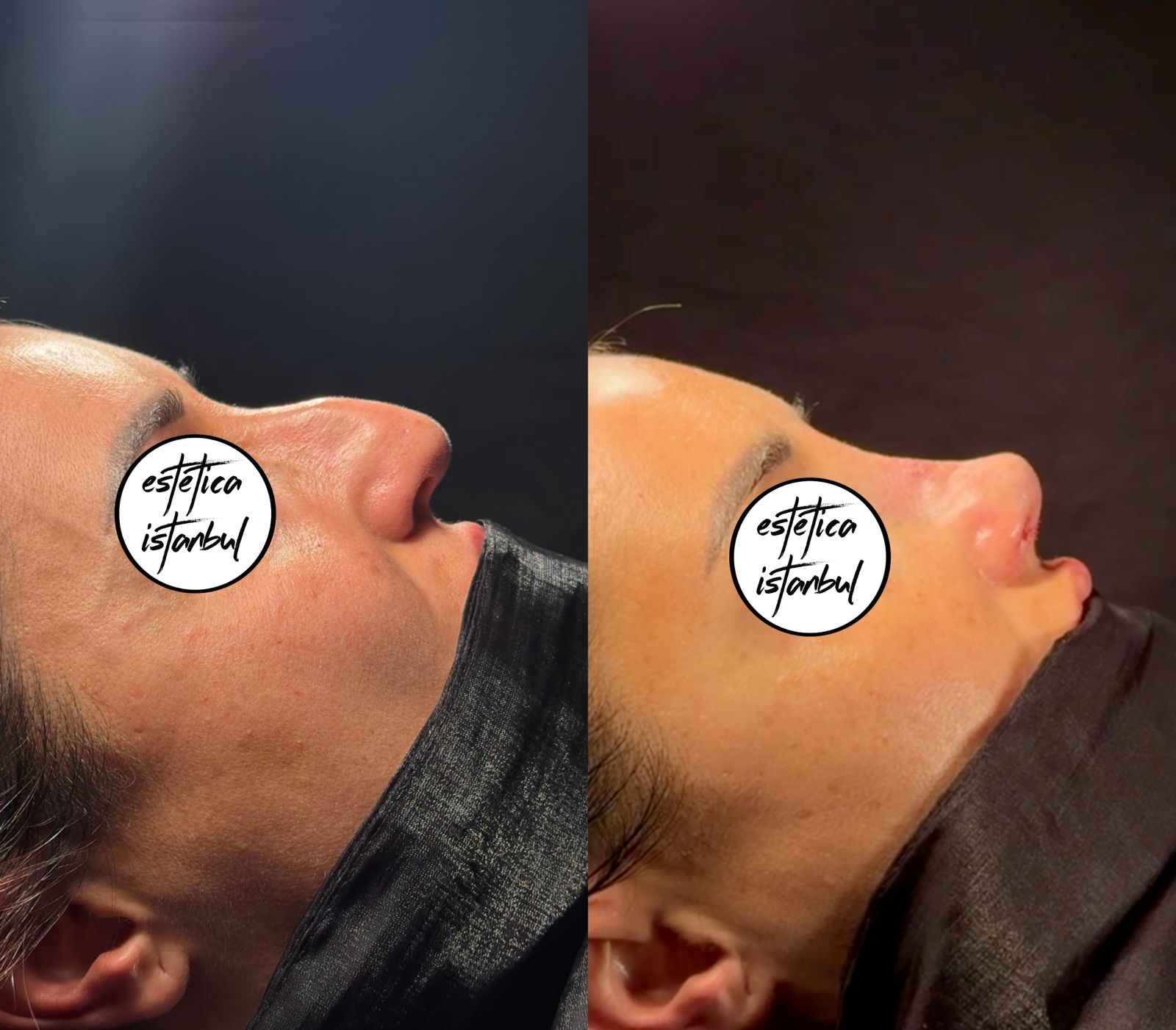 Isabella Beauty Fly | Turismo estético en Estambul